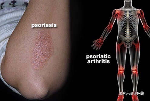 银屑病关节炎可视化指南