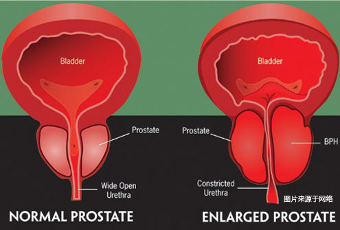 良性前列腺肥大（BPH, 前列腺增生）